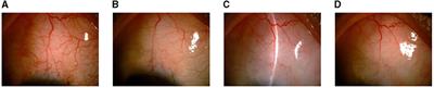 Microcatheter-Assisted Trabeculotomy Combined With Deep Sclerectomy and Trabeculectomy in Young to Middle-Aged Adults With Advanced Primary Open-Angle Glaucoma: 1-Year Result